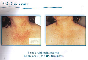 Chicago Laser Skin Tightening